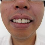 歯の色の悩み