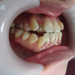 受け口・歯並びの治療