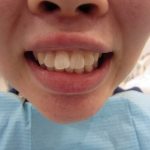 出っ歯の治療