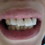 悪い噛み合わせによる前歯の突出