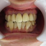 歯並び・前歯の変色の改善