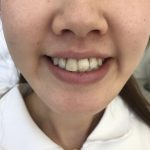 仮歯、歯の変色