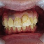 歯の変色・歯並び