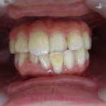 歯並び・歯の色改善