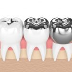 金属を使わない歯科治療（メタルフリー治療）