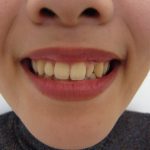 矮小歯の改善