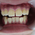すき間と歯の色の改善