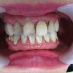 歯の色・虫歯の改善