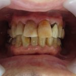 加齢による歯の黄ばみ