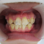 叢生(でこぼこ)歯並びの改善