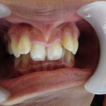 凹んだ歯並びの改善