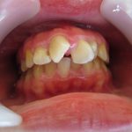前歯の歯並びの改善