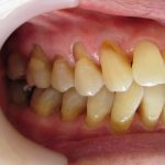 歯の根元のすり減り（くさび状欠損）