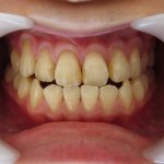 咬み合わせと歯の色の改善