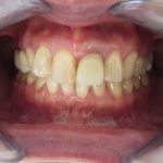 歯と歯の間の変色
