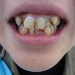 八重歯・歯並びの改善