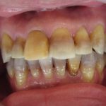 テトラサイクリン歯　生まれつきの歯の変色