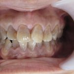 テトラサイクリン歯