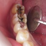 なぜ銀歯は二次う蝕になりやすいの？