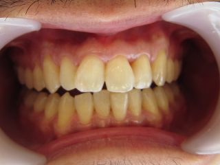 前歯の歯並びと色