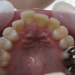 前歯の歯並び