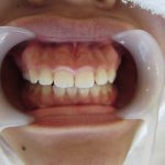 埋もれた前歯の改善（ガミースマイル）