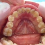 歯石除去はどれくらいの頻度で通えばいいの？