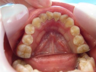 歯石除去はどれくらいの頻度で通えばいいの？