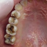 銀歯の下は真っ黒な虫歯　セレック治療