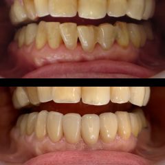前歯のすき間と歯並び
