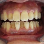 歯並びと歯の着色のお悩み