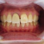 前歯のすき間と歯の根元の黒いライン