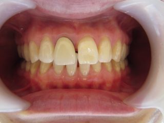 前歯のすき間と歯の根元の黒いライン