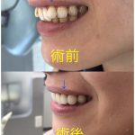 凹んだ前歯の改善