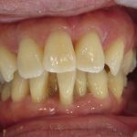下の前歯の歯並び改善