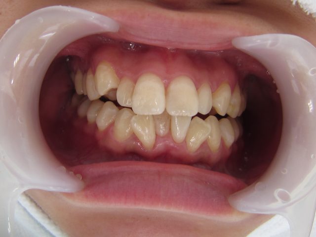 歯並びの改善　歯の色