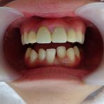 すきっ歯と歯並び