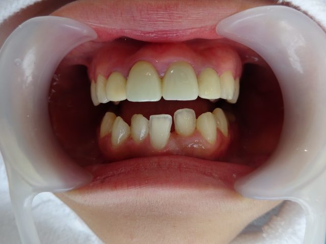 すきっ歯と歯並び