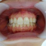 もっと歯を白くしたい