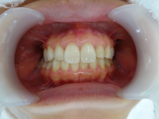 もっと歯を白くしたい