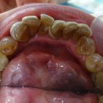 ラミネートベニアからセラミッククラウンに変える