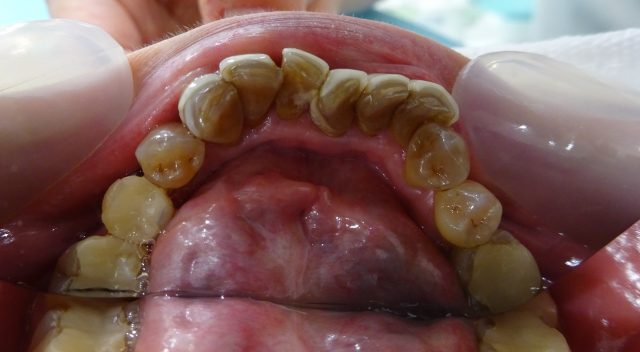 ラミネートベニアからセラミッククラウンに変える