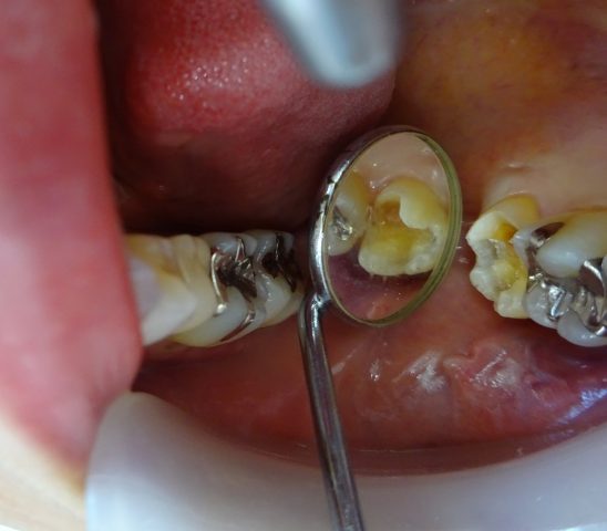 時短で虫歯治療