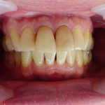 神経の死んだ歯　変色してきた