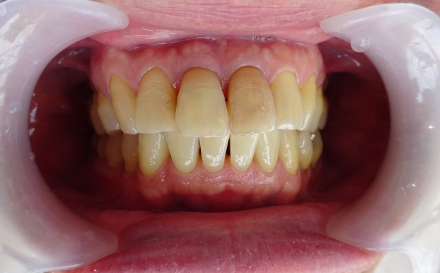 神経の死んだ歯　変色してきた