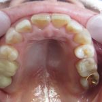 歯のすき間をマウスピース矯正で治す