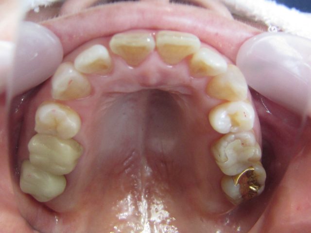 歯のすき間をマウスピース矯正で治す