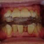 いびき防止マウスピース