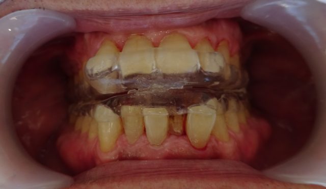 いびき防止マウスピース