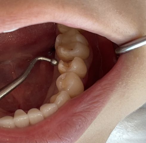 金属を使わない虫歯治療